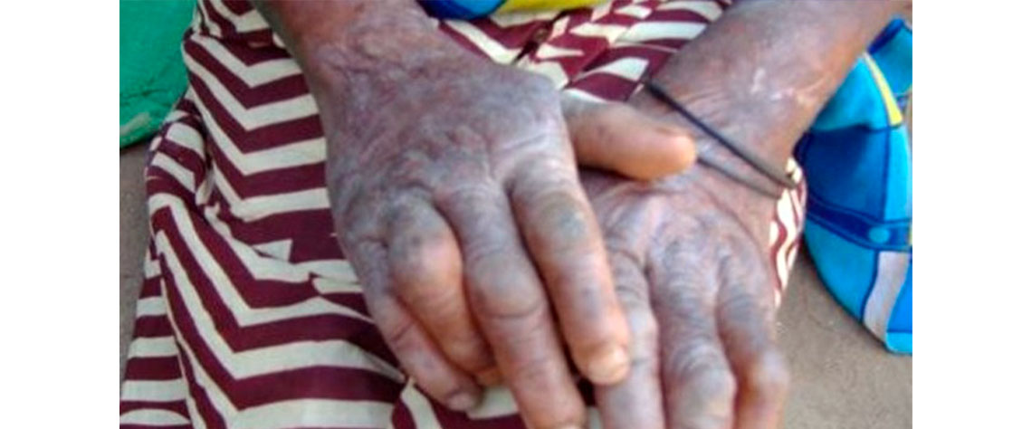 Lepra ataca 11 distritos da província da Zambézia